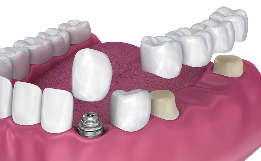 dental crowns